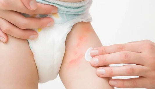 Do NOT put these products on your baby’s red, dry, and itchy butt