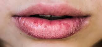 How to Get Rid of Eczema on Lips