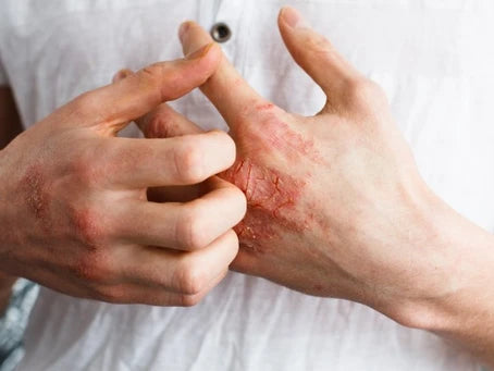 How to Get Rid of Dry Skin from Eczema with 5 Natural Supplements